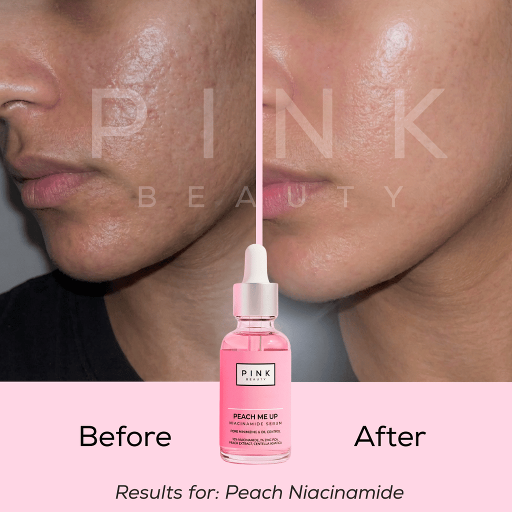 Before and after comparison of a person's cheek skin showing improved texture and tone, with a pink dropper bottle labeled PINK BEAUTY Peach Me Lip serum centered below. Text reads 'Before', 'After', and 'Results for: Peach Niacinamide'.