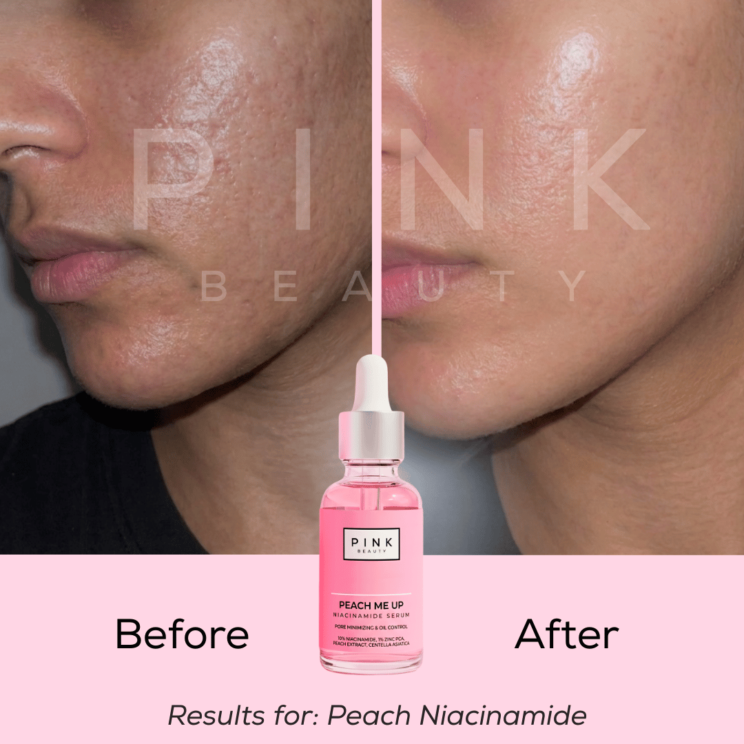 Before and after comparison of a person's cheek skin showing improved texture and tone, with a pink dropper bottle labeled PINK BEAUTY Peach Me Lip serum centered below. Text reads 'Before', 'After', and 'Results for: Peach Niacinamide'.