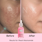 Before and after comparison of a person's cheek showing skin improvement, with a pink dropper bottle labeled PINK BEAUTY Peach Niacinamide centered below. Text at the bottom reads 'Before', 'After', and 'Results for: Peach Niacinamide'.