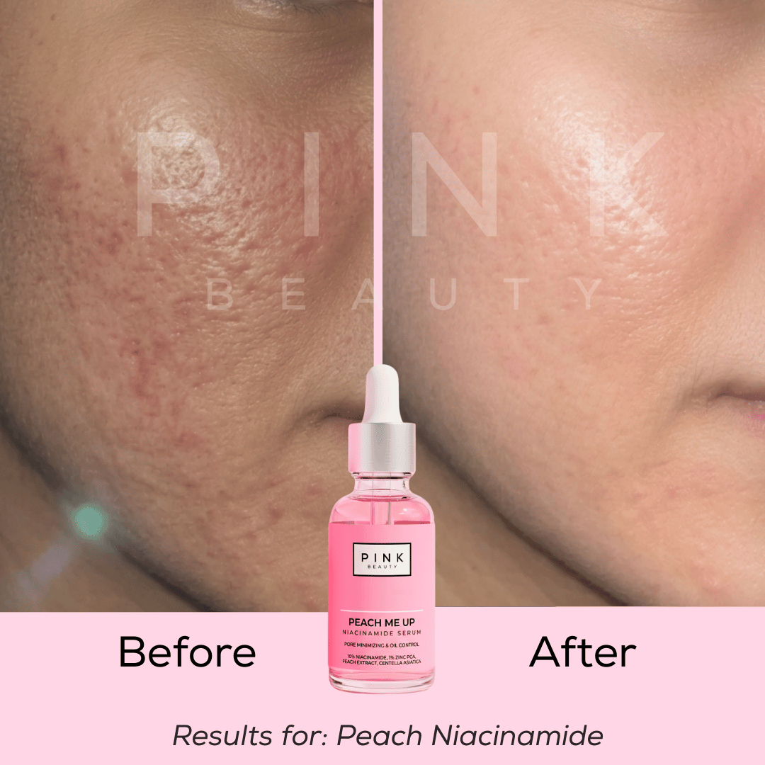 Before and after comparison of a person's cheek showing skin improvement, with a pink dropper bottle labeled PINK BEAUTY Peach Niacinamide centered below. Text at the bottom reads 'Before', 'After', and 'Results for: Peach Niacinamide'.