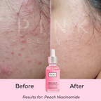 Pink Beauty Peach Me Up 10% Niacinamide Serum with 1% Zinc PCA and Peach Extract. Brightening serum for oily and acne-prone skin, enlarged pores, excess oil, acne marks, uneven skin tone, and dull skin. Lightweight hydration for glowing skin.