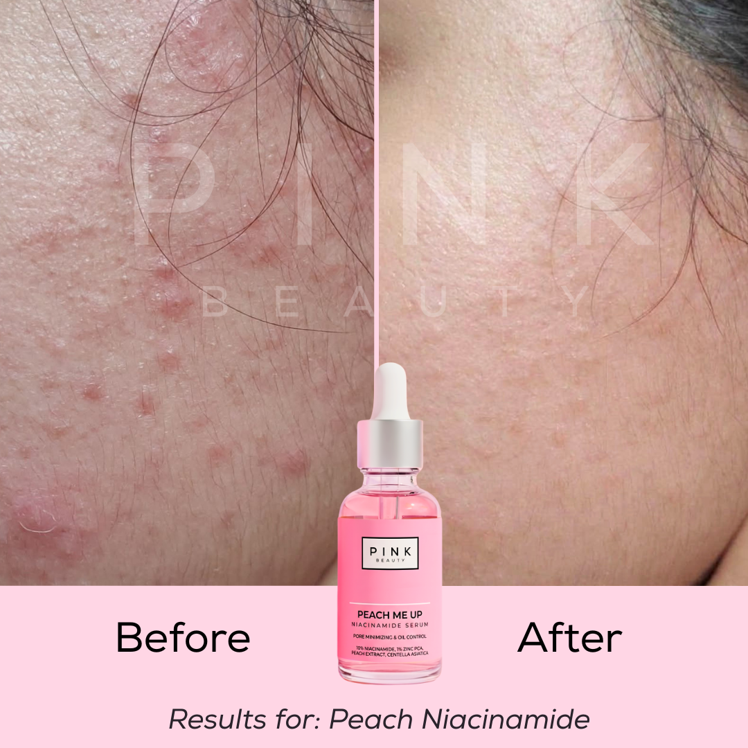 Pink Beauty Peach Me Up 10% Niacinamide Serum with 1% Zinc PCA and Peach Extract. Brightening serum for oily and acne-prone skin, enlarged pores, excess oil, acne marks, uneven skin tone, and dull skin. Lightweight hydration for glowing skin.