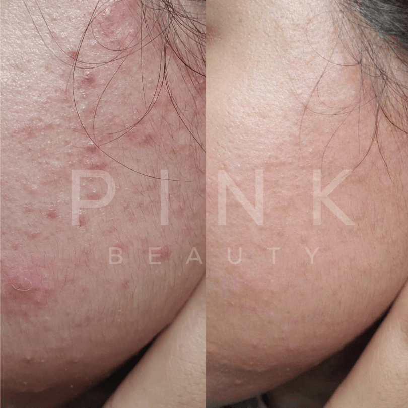 Pink Beauty Peach Me Up 10% Niacinamide Serum with 1% Zinc PCA and Peach Extract. Brightening serum for oily and acne-prone skin, enlarged pores, excess oil, acne marks, uneven skin tone, and dull skin. Lightweight hydration for glowing skin.