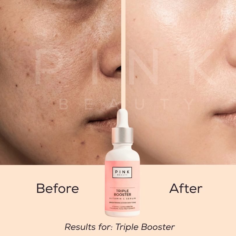 Before and after comparison of a person's cheek and nose area, showing acne improvement, with a bottle of PINK BEAUTY Triple Booster Vitamin Serum centered below. Text reads 'Before,' 'After,' and 'Results for: Triple Booster.